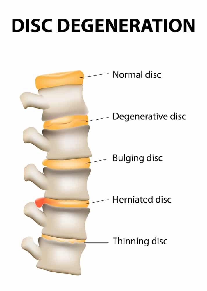 The Aging Spine and Degenerative Disc Disease